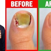 Kerassentials: Healthy Nails and Better Skin, Don’t Buy Before Read!